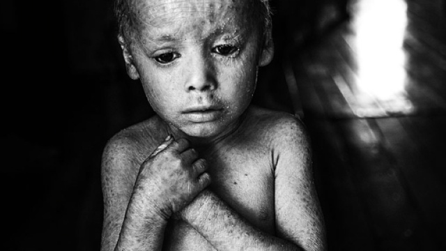 Effetti glifosato su un bambino argentino