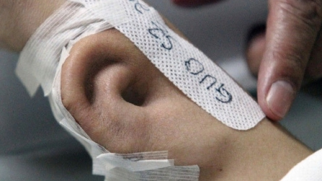 L'orecchio ricresciuto sul braccio