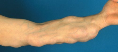 V&aacute;rios lipomas em bra&ccedil;o (imagem de arquivo).