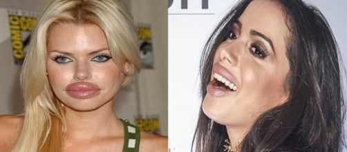 Preenchimentos de botox que n&atilde;o deram muito certo