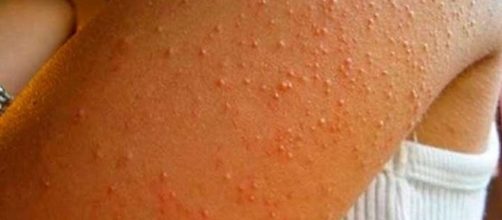 O gl&uacute;ten &eacute; um dos respons&aacute;veis pelo aparecimento dessas bolinhas nos bra&ccedil;os