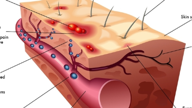 Varicella 'cattiva': importante vaccinarsi