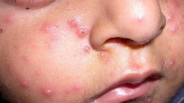 Un caso molto evidente di varicella
