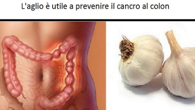 Tra le molteplici virt&ugrave; dell'aglio c'&egrave; anche una documentata attivit&agrave; preventiva del tumore al colon.