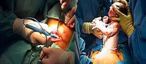 M&eacute;dico precisou arrancar cabe&ccedil;a de beb&ecirc; para concluir parto de emerg&ecirc;ncia em Toledo