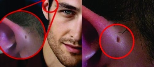 Marca na orelha est&aacute; estatisticamente ligada a perdra nos rins e perda da audi&ccedil;&atilde;o