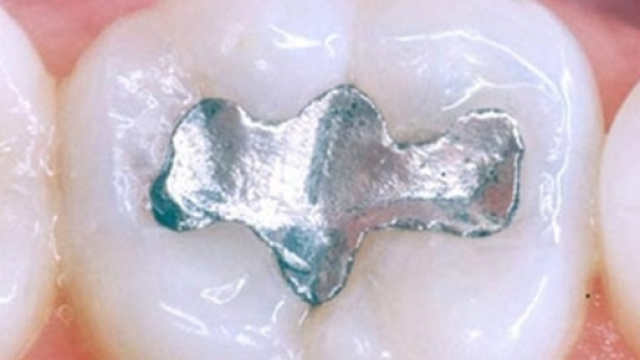 Amalgama dentale nociva? &Egrave; scontro tra le Iene e la Ceo.