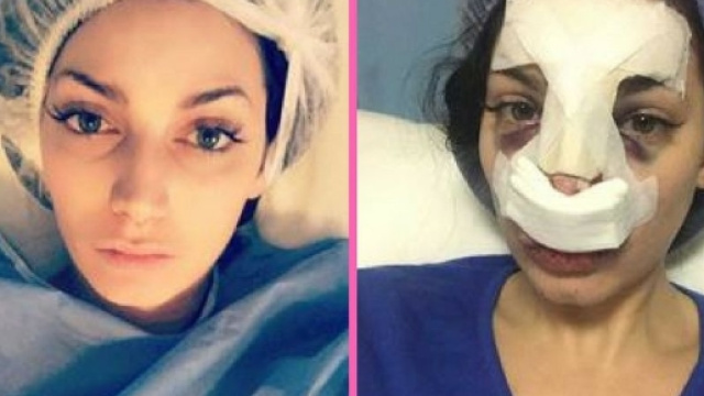 Secret Story : Nad&egrave;ge Lacroix s'est fait refaire le nez !