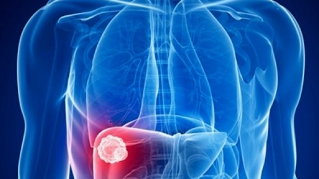 La carenza di vitamina D si associa alla steatosi epatica non alcolica.