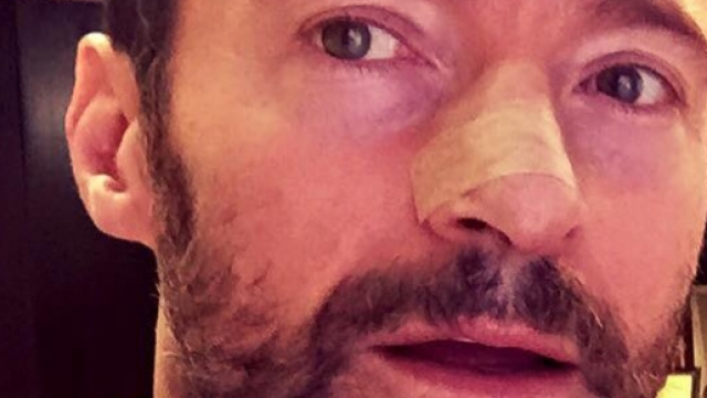 Hugh Jackman mostra su Facebook il suo cancro