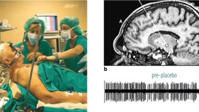 neurone in paziente con Parkinson (F. Benedetti)