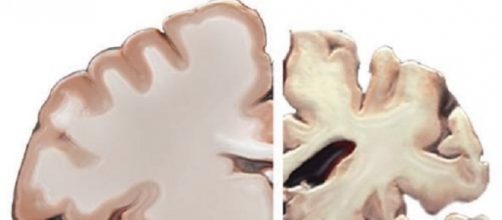 Healthy and Alzheimer's brains (NIH)