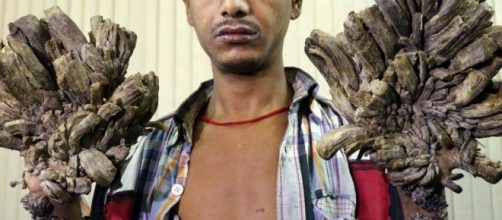 Verrugas causadas por Papiloma V&iacute;rus Humano-HPV