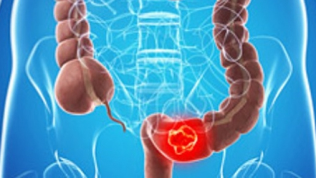 Screening per una diagnosi precoce del tumore