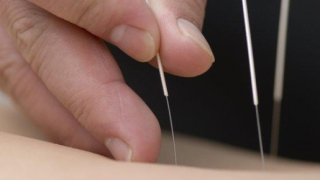 Un agopuntura durante l'applicazione degli aghi