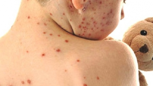 Aumento dei casi di morbillo negli USA e in EU