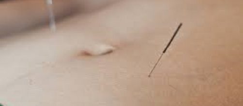 Acupuncture can treat irritable bowel syndrome.