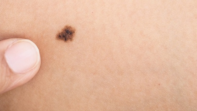 Risultati incoraggianti sul melanoma metastatico da un nuovo farmaco, il Nivolumab (Opdivo).
