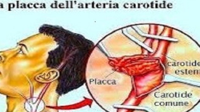 Le arterie e le placche aterosclerotiche
