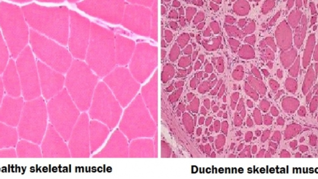 Tessuto muscolare sano (a sinistra) e affetto da distrofia di Duchenne (a destra)