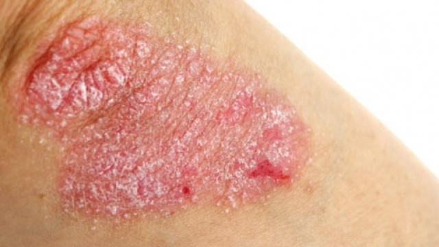 Un caso di Psoriasi, malattia della pelle