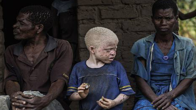 Gli albini in Africa vengono uccisi sistematicamente