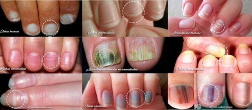 As unhas podem mostrar muito sobre o que passa em nosso organismo se forem bem observadas.