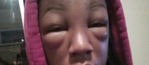 Rea&ccedil;&atilde;o al&eacute;rgica aos medicamentos antidepressivos