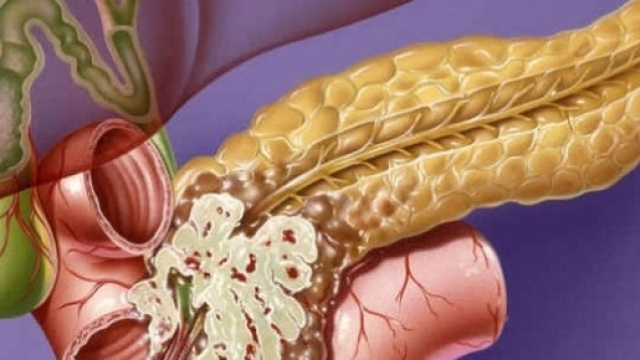 Rappresentazione schematica di tumore al pancreas. Adattato da http://www.horsemoonpost.com/