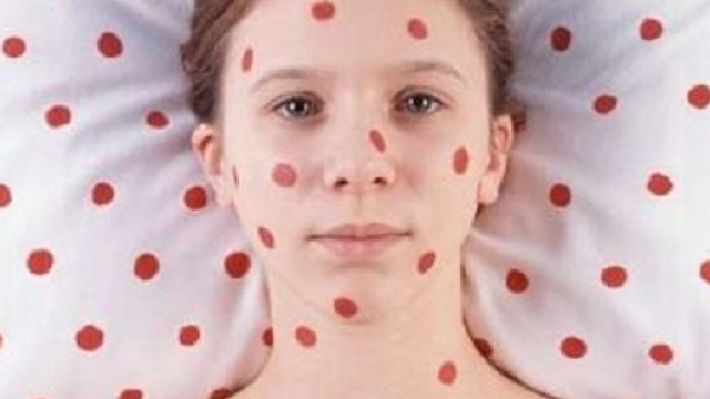 Tra giugno 2015 e maggio 2016 in Italia ci sono stati 515 casi di morbillo. Il maggior numero nei 26 Paesi della UE,