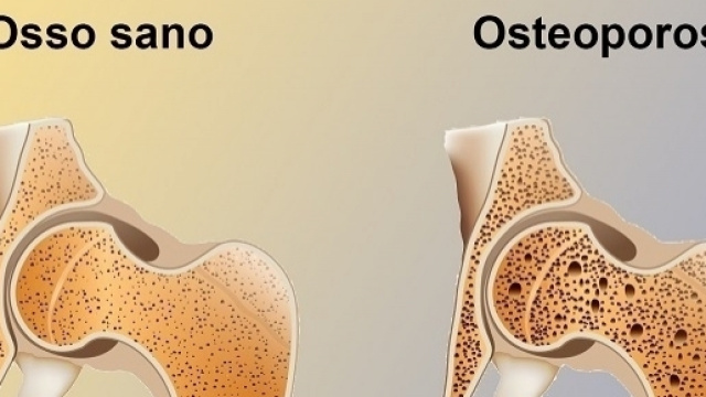 L'osteoporosi colpisce principalmente le donne nell'et&agrave; post-menopausa. Anche gli uomini non ne sono esenti.