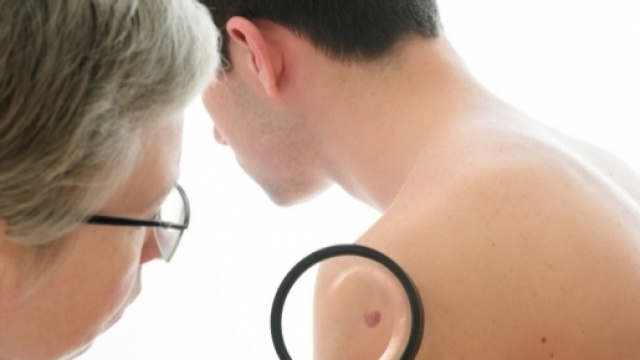 melanoma-benigno-maligno-test-1024&times;682 | Mediskope - mediskope.com