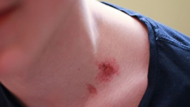 Messico: 17enne muore per succhiotto sul collo