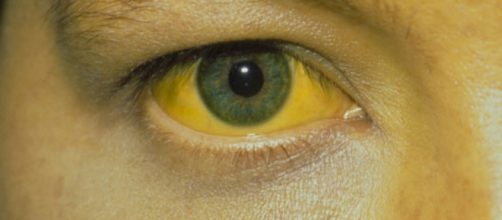 ictericia por bilirrubina alta - SegundoM&eacute;dico - segundomedico.com