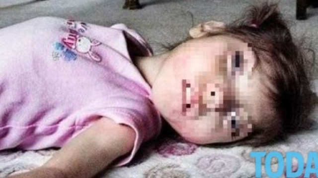 Gabby Williams &egrave; uni dei rarissimi casi di sindrome di Benjamin Button