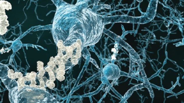 Placche amiloidi attorno ai neuroni