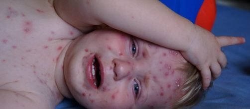 Chickenpox Becoming Rarer Thanks to Two-Dose Vaccine &ndash; Jilard ... - jilard.com