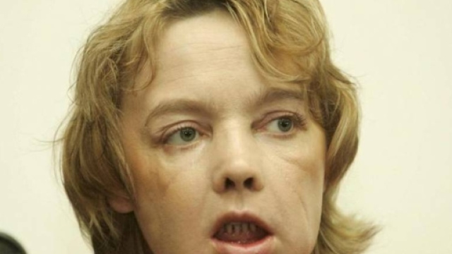 Morta la donna che ebbe il primo trapianto di viso della storia