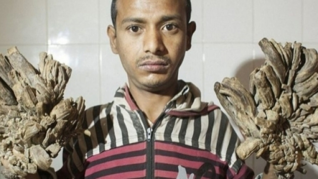 Verruche che sembrano rami: lo strano caso dell'uomo-albero