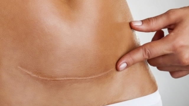 Parto cesareo: proposte di legge contro gli abusi.