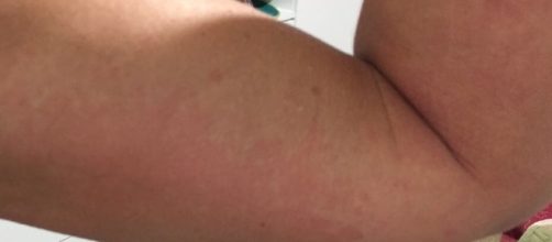 Processo al&eacute;rgico por efeito cumulativo de conservantes