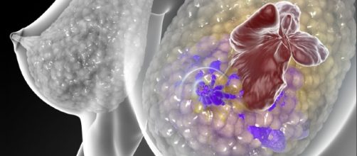 New 'mutation-tracking' blood test could predict breast cancer ... - medicalxpress.com