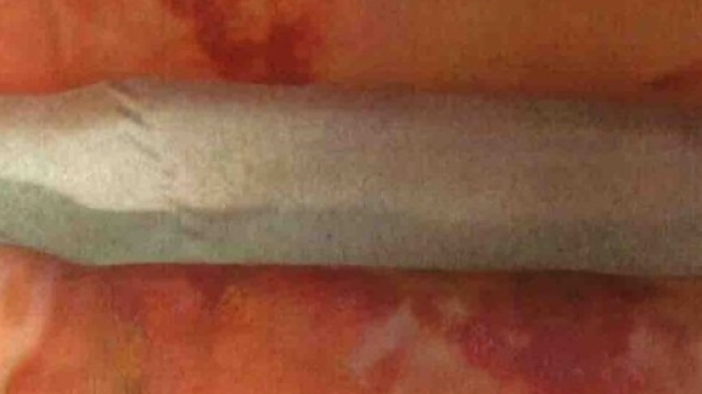 Inghilterra, braccia ustionate per il sugo di pollo rovente