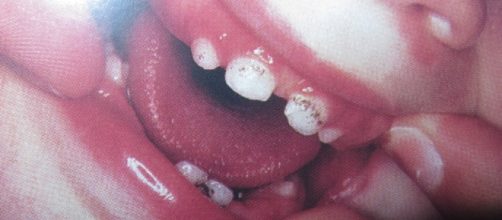 Dentes de leite com manchas escuras