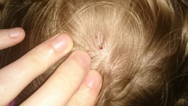 Galles, box doccia scoppia: bimba ferita