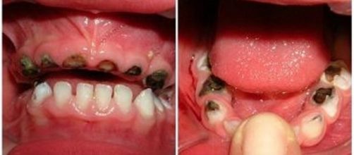 Comprometimento da sa&uacute;de oral do beb&ecirc; pela c&aacute;rie de mamadeira