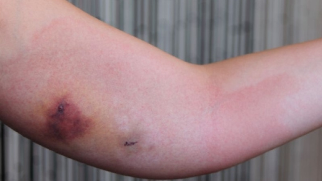 Morsa da Ragno VIOLINO , Forum Natura Mediterraneo | Forum ... - naturamediterraneo.com