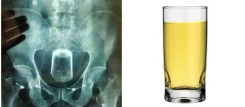 Homem introduz copo de vidro em seu &acirc;nus