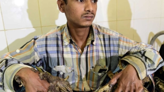 Bangladesh, verruche lo fanno diventare 'uomo albero'
