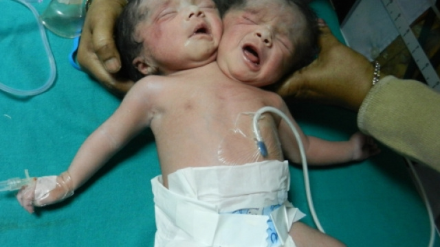 Messico, bimbo nasce con 2 teste: lo sconcerto dei parenti